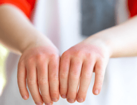 Eczema in children