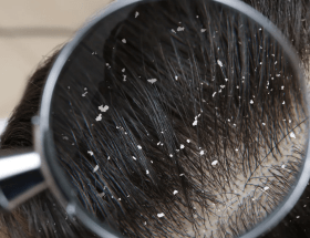How To Treat Dandruff