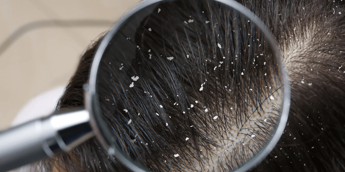 How To Treat Dandruff